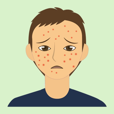 イラスト：皮膚アレルギーの症状